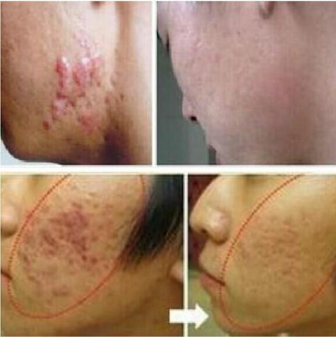 Image of Acne Scar Removal Cream