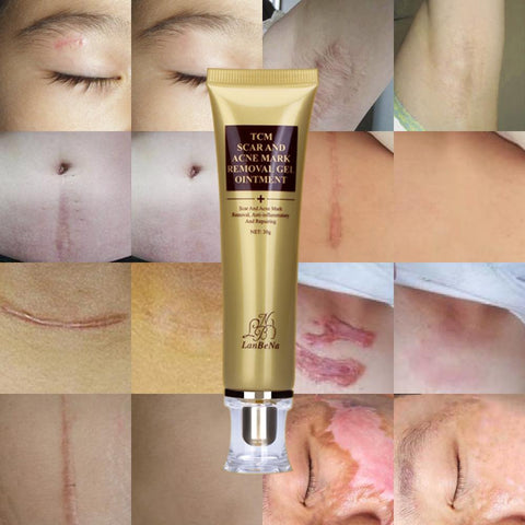Image of Acne Scar Removal Cream
