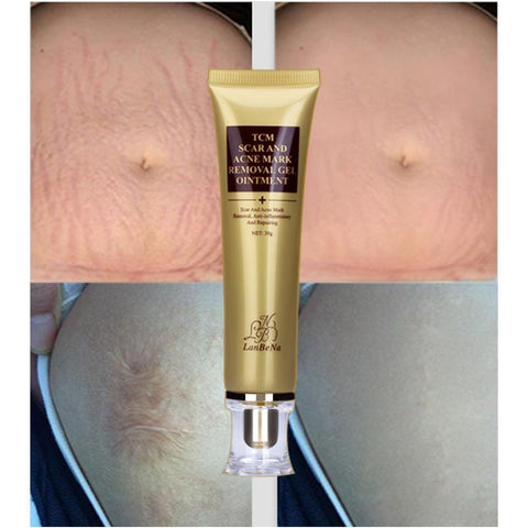 Image of Acne Scar Removal Cream