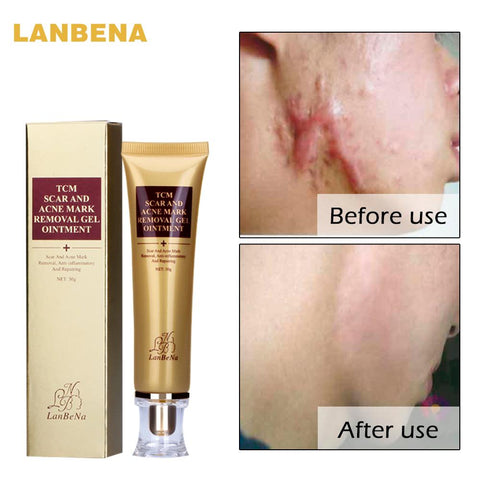 Image of Acne Scar Removal Cream